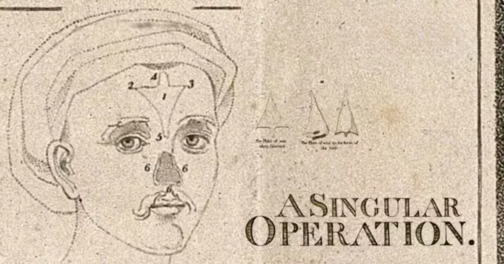 How British Surgeons “Rediscovered” Indian Plastic Surgery